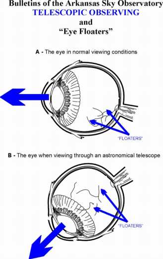 Eye Floaters